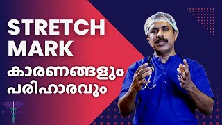 HOW TO REMOVE STRETCH MARKS MALAYALAM | CAUSES | TREATMENT |  Dr NAZER