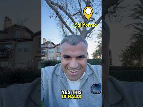 4 months after my hair transplant.