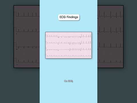 Atrial fibrillation overview