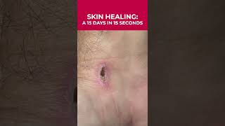 15 Days of Skin Healing in 15 Seconds: Amazing Timelapse! 🩹