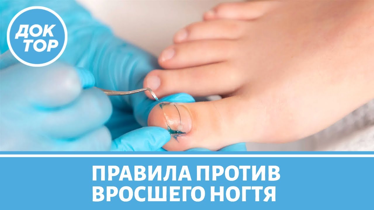 Чем опасен вросший ноготь / Как его правильно лечить