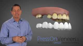 Don't Buy DENTURES | You have another Choice