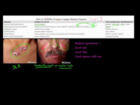80P - Examples of Immune Complex-Mediated Diseases, Type III Hypersensitivity
