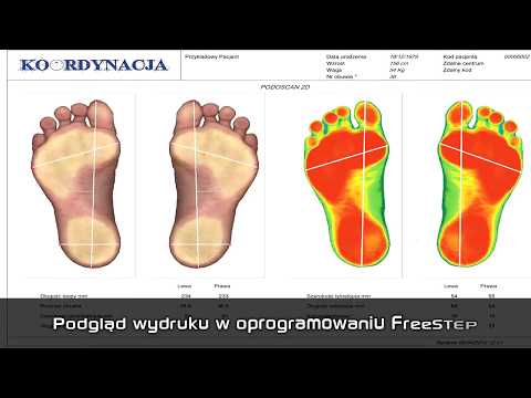 Deformacja stóp jest Odzyskiwanie po operacji halyus koślawego