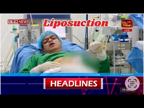 News Self Abdominal liposuction and Facial fat graft by Dr Ananda Jayawardena Consultant Surgeon 