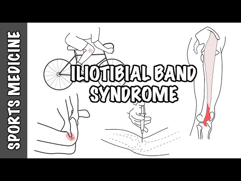 Síndrome de la banda iliotibial (ITBS): descripción general