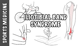 Iliotibial Band Syndrome (ITBS) - Overview