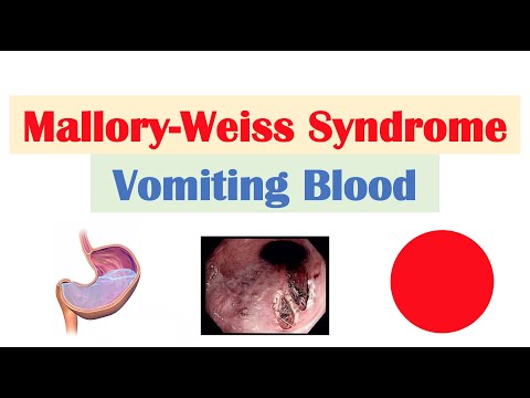 Irritable Bowel Syndrome IBS Causes Symptoms Bristol Stool Chart Types and Treatment