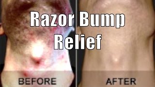 ASPIRIN RAZOR BUMP RELIEF | Cheap Tip #8