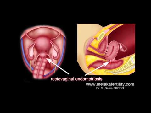 Chirurgie laparoscopique de l'endométriose