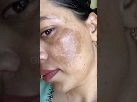 What to do #pigmentationremedy #melasma #pigmentation #hyperpigmentation