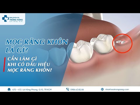 Mọc răng khôn là gì? | Cần làm gì khi có dấu hiệu mọc răng khôn?