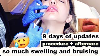 LIP FILLERS - First time *tips for faster healing*