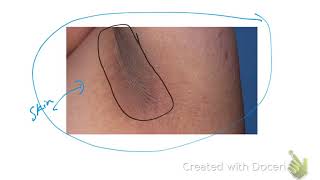 Polycystic ovary syndrome