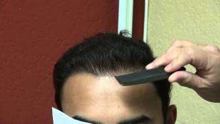 preview picture of video 'Receding Frontal Hair Loss Transplant Surgery Los Gatos California Dr. Diep www.mhtaclinic.com'