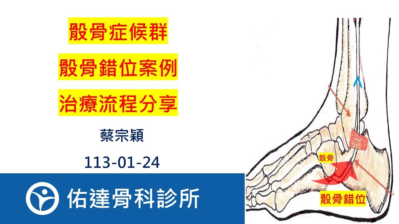 骰骨症候群、骰骨錯位症候群、骰骨脫位錯位、骰骨卡住、Cuboid syndrome、Cuboid subluxation、Locked cuboid：治療流程分享 【佑達骨科】【蔡宗穎醫師】 - AI健康醫療影片