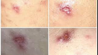 How to Get Rid of Acne Scab Overnight FAST | 9 Home Remedies to Get Rid of Acne Scars