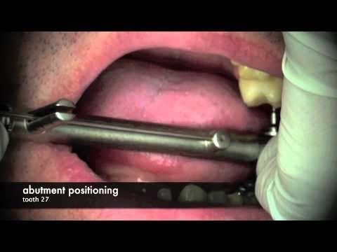 ZemFix® - The innovative cementing - Implant-crowns and abutments [Full HD]