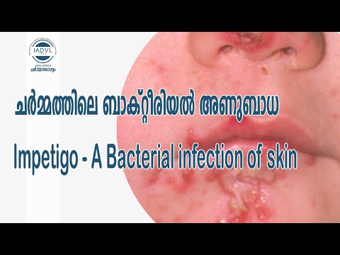 Impetigo - ചർമ്മത്തിലെ ബാക്റ്റീരിയൽ അണുബാധ