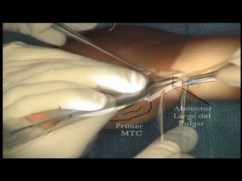 De Quervain Syndrome First Extensor Compartment Release