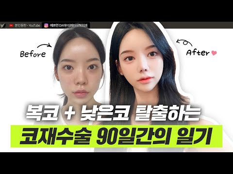 복코재수술, 눈재수술, 얼굴라인 변화까지! 완전히 달라진 얼굴 성형 브이로그ㅣ디에이성형외과