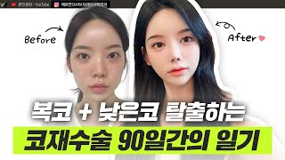 복코재수술, 눈재수술, 얼굴라인 변화까지! 완전히 달라진 얼굴 성형 브이로그ㅣ디에이성형외과