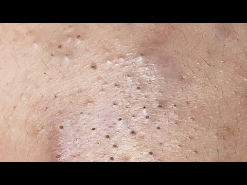 Super Satisfying BLACKHEAD REMOVAL – Major Closeup