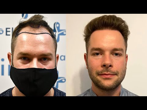 Hair Transplant Before and After - Month by Month...