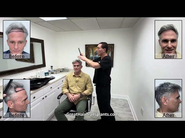 Dr. Brett Bolton MaxHarvest Procedure patient James