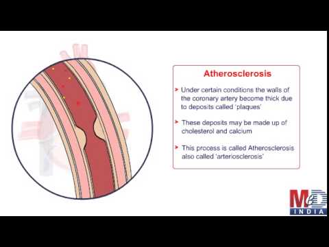 Health Animation - Animation on Coronary Artery Bypass Surgery (CABG)