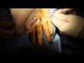 Hand Surgery Procedure Trigger Finger Surgery