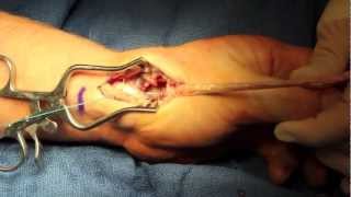 Surgery Thumb Arthroplasty and Ligament Reconstruction (LRTI) for Arthritis