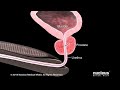 What is Benign Prostatic Hyperplasia (BPH)?