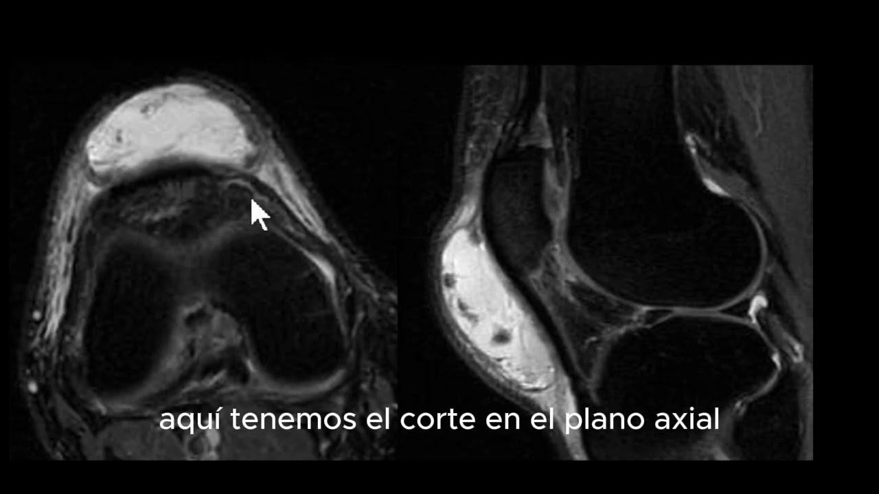 bursitis prepatelar