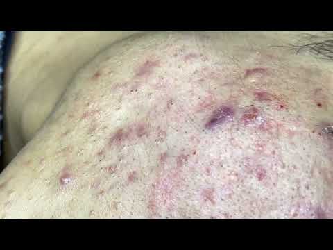 Ngoc Ha Acne Treatment #81125