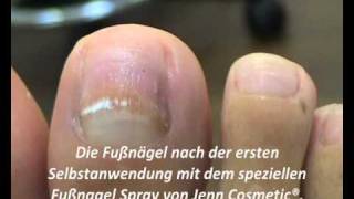 Zehennagel ablösen Das spezielle Fußnagel Spray von Jenn Cosmetic ®.
