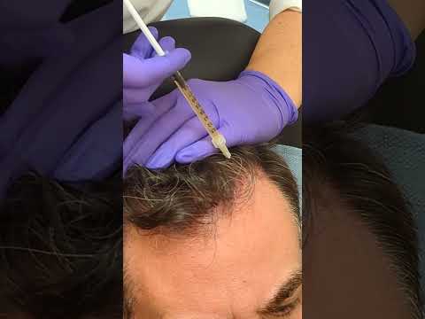 PRP Hair Restoration