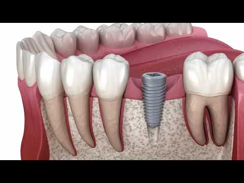 Dental Implants — video thumbnail