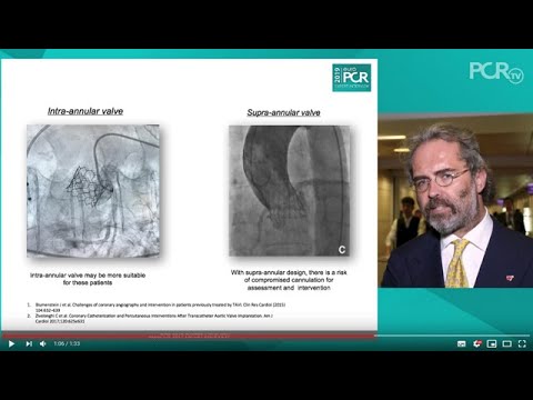 Challenges with re-accessing the coronaries after TAVI - EuroPCR 2019