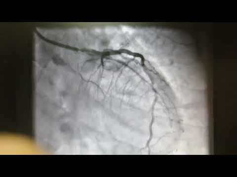 Diabetic patient with poor sugar control|| Angioplasty(CTO proximal dominant Rca & CTO proximal Lcx)