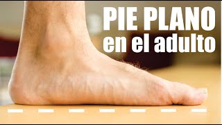 PIE PLANO o CAÍDO en ADULTOS 👣 Síntomas Terapia Tratamiento Cirugía 🦶🏼  Dr EDSON SERRANO ⭐ Neomedica