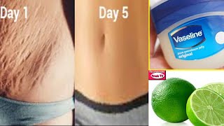 How To Get Rid Stretch marks Fast naturally and Permanently at Home in 5 days ( Easy & 100% Works )