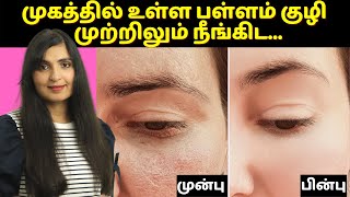 Instant OPEN PORES Removal | How To Get Rid of LARGE PORES in 3 Days | 100% Results |  #OpenPores