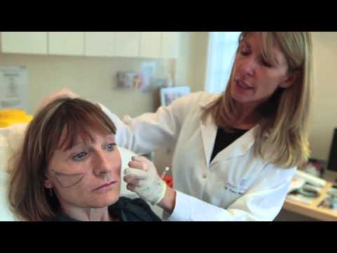 Non-surgical facelift (the Y-Lift) with Restylance sub-Q Dermal Filler