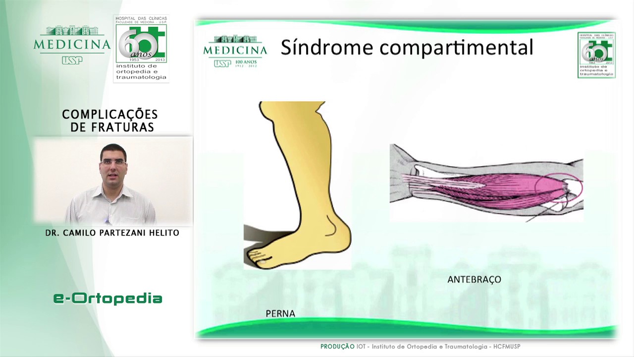 Complicações de Fraturas - Dr. Camilo Partezani Helito