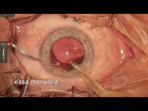 Como Girar uma Lente Intraocular