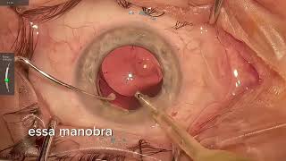 Como Girar uma Lente Intraocular