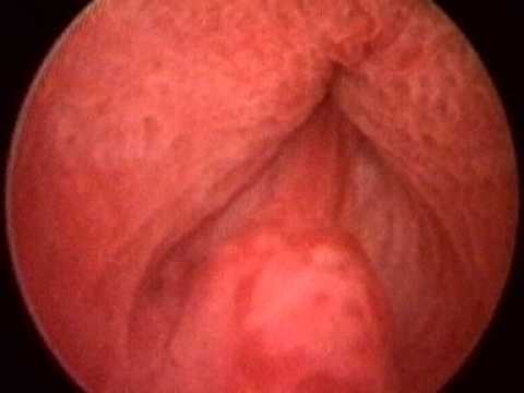 Die Behandlung der chronischen Prostatitis bei jungen Männern Beim Aufheben Prostata Schmerzstärke