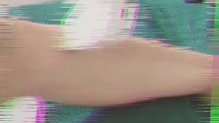 Why should we choose diode laser for hair removal?