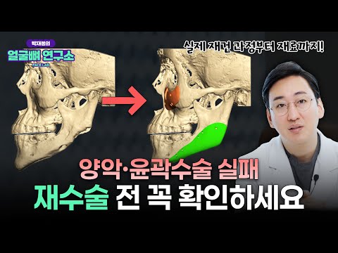 양악수술, 윤곽수술 실패 후 재수술 재건수술 고민중이라면 필수시청! 재건술 재료부터 과정, 실제사례